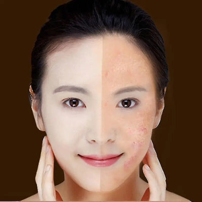 Stylo de luminothérapie rouge et bleu My Store